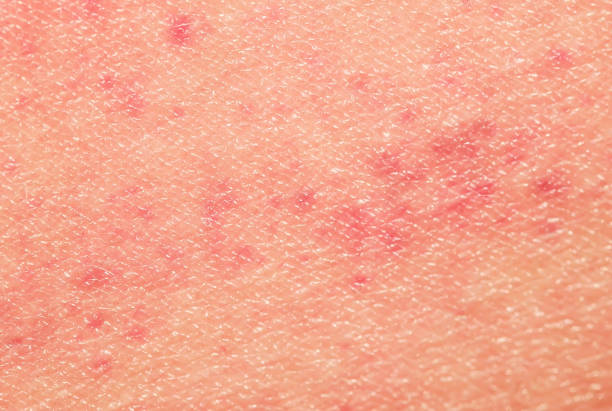 istock sick human skin texture covered with red allergic spots and irritations 1040548318
