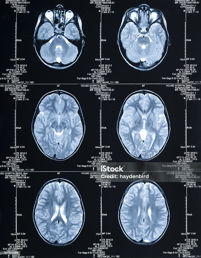 Cerveau montrant Scanner à résonance magnétique plusieurs images de la tête et du crâne - Photo de Cancer du cerveau libre de droits