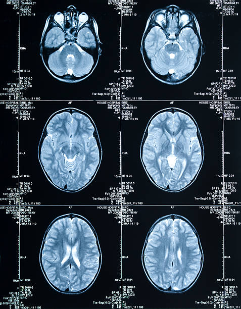 cerveau montrant scanner à résonance magnétique plusieurs images de la tête et du crâne - corpus striatum photos et images de collection