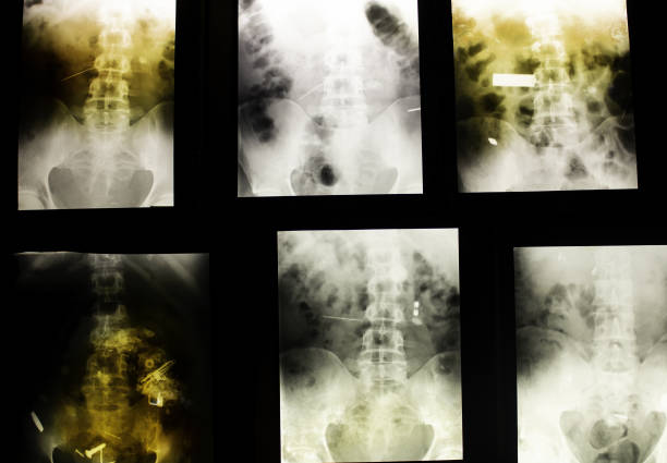 istock Medical radiographs hip 1041094354