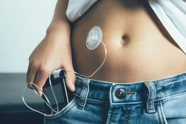 young diabetic patient keeps an insulin pump in the pocket - medical equipment doctor healthcare and medicine equipment imagens e fotografias de stock