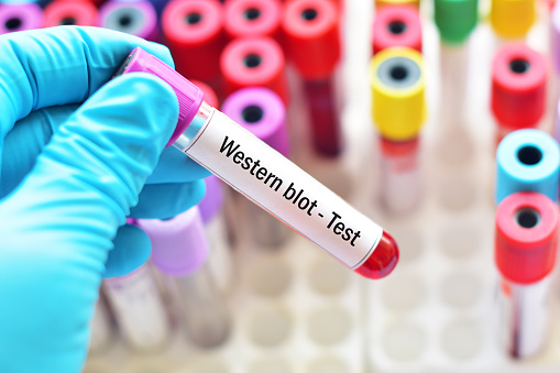 Blood For Western Blot Test Stock Photo - Download Image Now - AIDS, AIDS  Test, Analyzing - iStock