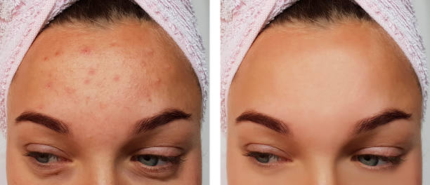 girl pimples on the forehead before and after the procedure girl pimples on the forehead before and after the procedure allergy medicine photos stock pictures, royalty-free photos & images