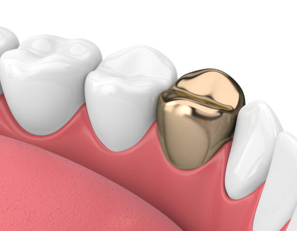istock 3d render of teeth with dental golden crown 1041640324