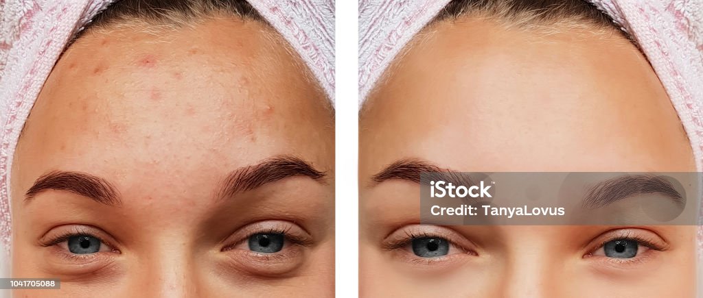 tratamento de olho linda garota, antes e após procedimentos, acne - Foto de stock de Acne royalty-free