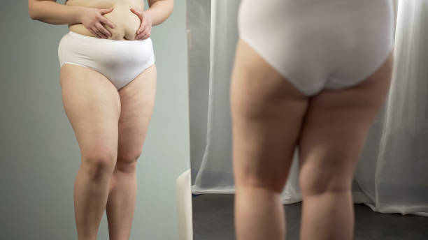 istock Obese lady looking in mirror, cellulite and stretch marks on hips and big belly 1041785568