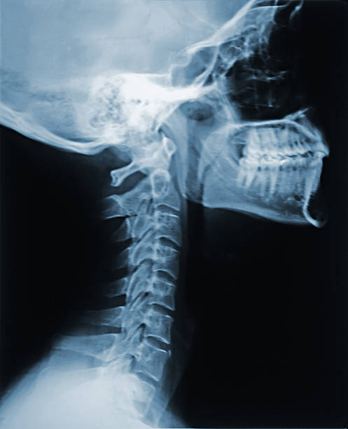 x-ray (네클 - orthopedic equipment osteoporosis x ray human spine 뉴스 사진 이미지