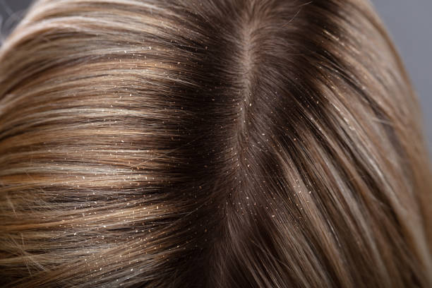 Dandruff In Woman's Hair Close-up Of A Dandruff In Woman's Blonde Hair dandruff stock pictures, royalty-free photos & images