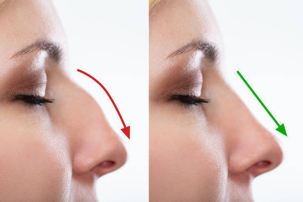 woman's nose before and after plastic surgery - nose job imagens e fotografias de stock