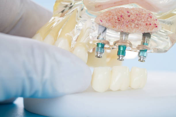 istock Implant and orthodontic model. 1042833176