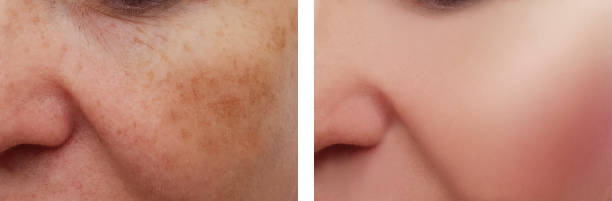 istock woman face wrinkles pigmentation before and after procedures 1043135490