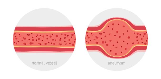 bildbanksillustrationer, clip art samt tecknat material och ikoner med friska och sjuka aneurysm mänskliga fartyg - aorta