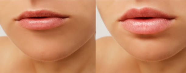 mädchen lippen zu erhöhen, vor und nach verfahren - big lips stock-fotos und bilder