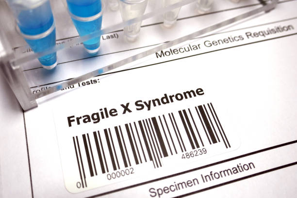 istock Fragile X syndrome 1043988820