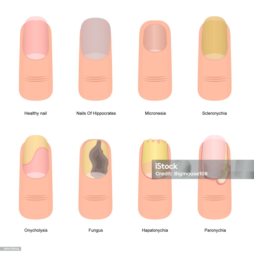 Ilustración de Dibujos Animados Color Uñas Enfermedades Icono Conjunto  Vector De y más Vectores Libres de Derechos de Uña del dedo del pie - iStock