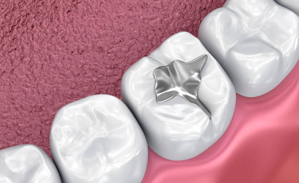 istock Fissure dental fillings, Medically accurate 3D illustration 1044235006
