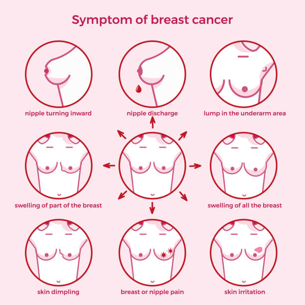 Symptoms of breast cancer. Symptoms of breast cancer. Medicine, pathology, anatomy, physiology, health. Info-graphic. Vector illustration. Healthcare poster or banner template. breast cancer stock illustrations