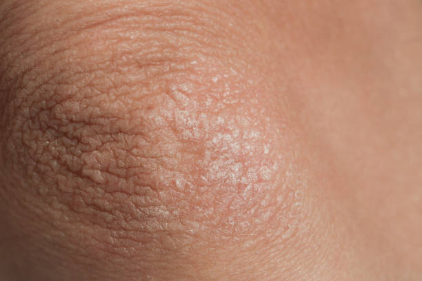 istock Winterizing dry itchy skin on the elbow area 1044792814