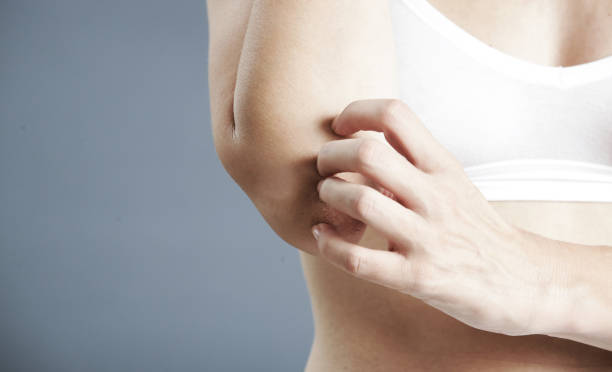 istock Winterizing dry itchy skin on the elbow area 1044795720