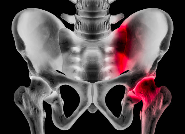 radiographie du bassin humain vue antérieure rouge fait saillant de l’articulation sacro-iliaque et de la douille de hanche à droite douleur zone-3d illustration médicale et biomédicale - human anatomy and medical concept-noir arrière-plan - hip femur ilium pelvis photos et images de collection