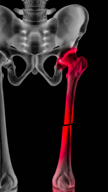 x-ray of broken upper leg or femur fracture anterior view completed displaced fracture type red highlight on pain area- 3d medical illustration- human anatomy and medical concept- on black background - human upper body xray imagens e fotografias de stock