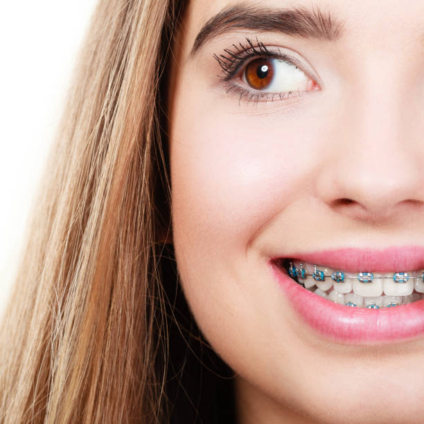 istock Woman showing her teeth with braces 1044955644