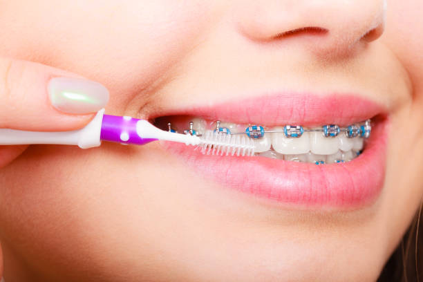 istock Woman brushing teeth with braces using brush 1044956016