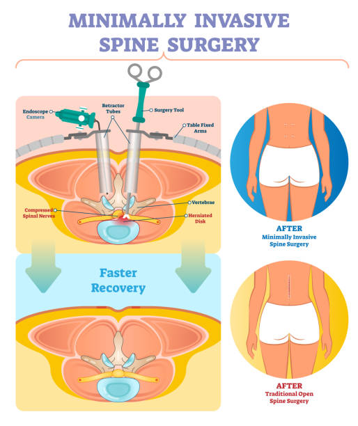 Minimally invasive spine surgery vector illustration. Labeled diagram. Minimally invasive spine surgery vector illustration. Labeled medical diagram with endoscope camera, retractor tubes, tool, table fixed arms and compressed spinal nerves. spinal surgery recovery stock illustrations