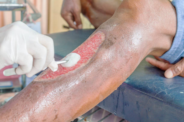infikovaná noha rány - gangréna - stock snímky, obrázky a fotky