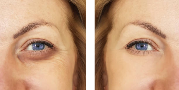 woman, eye swollen before and after procedures, treatm - wrinkles eyes imagens e fotografias de stock