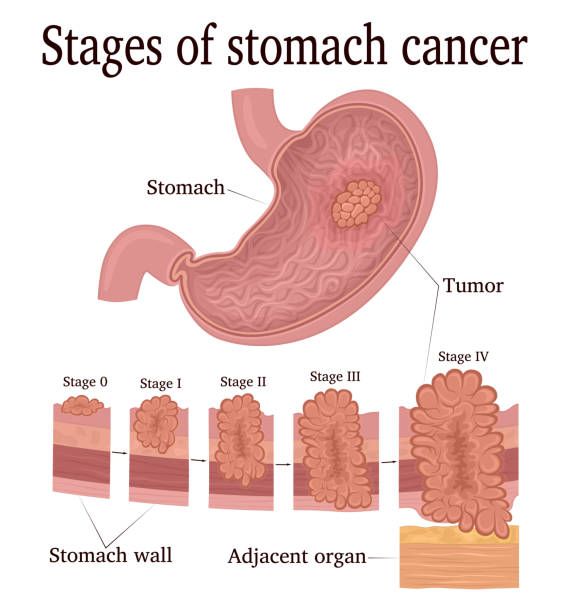 ilustrações de stock, clip art, desenhos animados e ícones de stages of stomach cancer - cancro gástrico