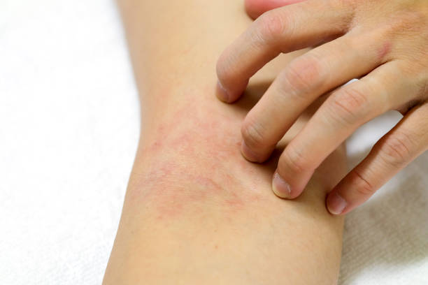 istock Women's hands are scratching allergy to red rash on white background 1045306044
