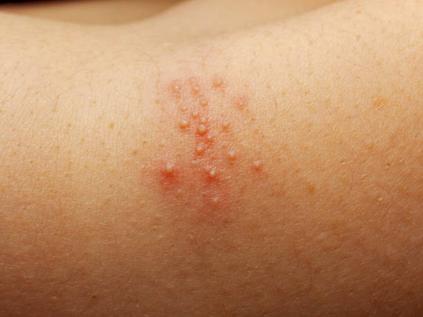 Rash and other nonspecific skin eruption Close up of girl has rash and other nonspecific skin eruption on her shoulders. May be caused by dirt, virus, mold, or bacteria. The doctor is currently diagnosed thorn photos stock pictures, royalty-free photos & images