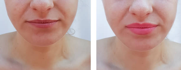 istock lips increase girl before and after 1045387564