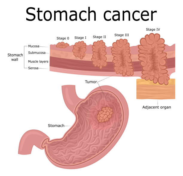ilustracja raka żołądka - mucosa stock illustrations