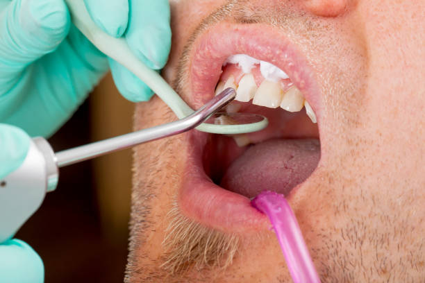 zahnärztlichen behandlung - dental hygiene dentist office dental drill handpiece stock-fotos und bilder