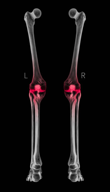 radiographie de la jambe humaine os vue postérieure rouge faits saillants dans l’arthrite osseuse du genou commune douleur zone-3d médicale et biomédicale illustration-healthcare-human anatomy et medical concept-noir et couleur blanche - human knee pain human spine human joint photos et images de collection