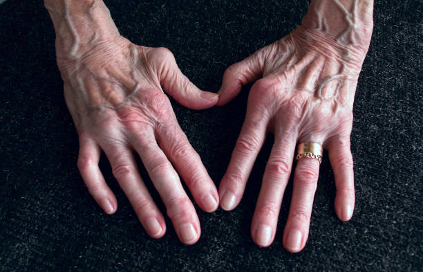 händer efter ledgångsreumatism 私 fyrtio år kvinna med arthrit som 私 vissa fingerleder 余計 stelopererad、heberdenska knutor - deformed ストックフォトと画像