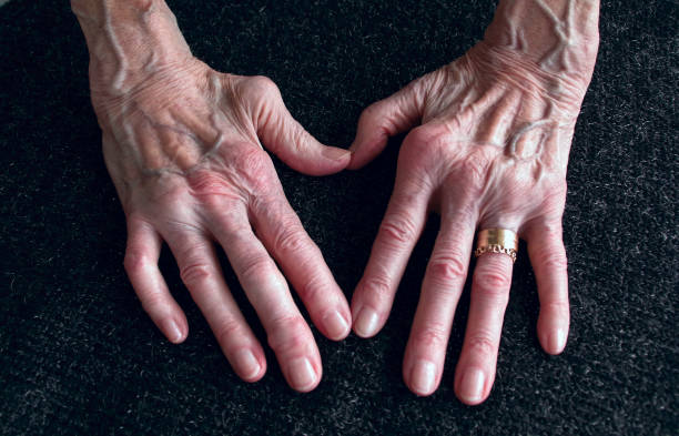 hands after rheumatoid arthritis for forty years- woman with arthritis who in some finger joints has been stiffened, heberdean nodules - rheumatism imagens e fotografias de stock