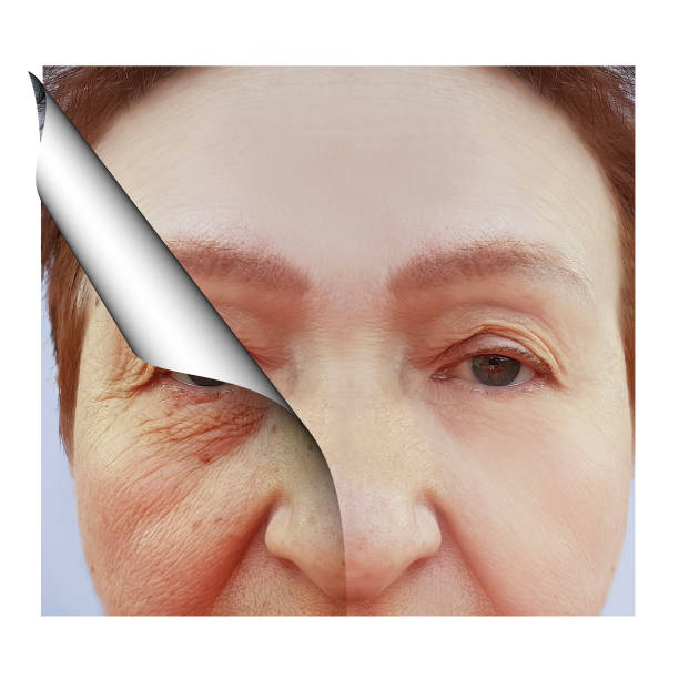 istock woman elderly wrinkles on face, before and after procedures collage 1046610772