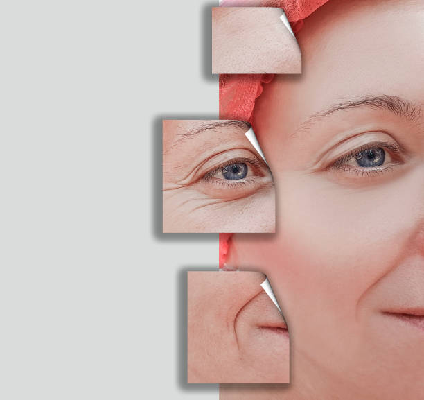 istock woman wrinkles on face, before and after procedures collage 1046631418