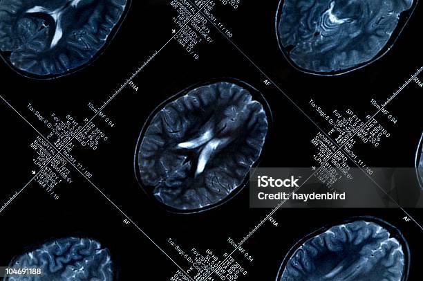 Mri Scan Mit Gehirn Mehrere Bilder Von Kopf Und Totenkopf Stockfoto und mehr Bilder von Alzheimer-Krankheit