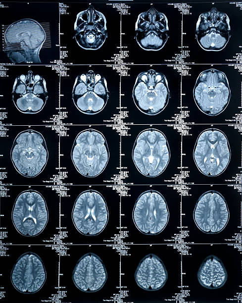 mri 複数のイメージが表示される脳スキャンの頭とスカル - brain mri scan alzheimers disease medical scan ストックフォトと画像