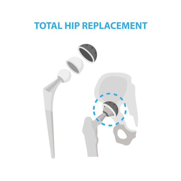 엉덩이 관절 그리고 엉덩이 교체 수술 의료 infographic 요소 흰색 배경에 고립의 관절염. 인공 고관절 건설 금속 infographic 요소에서 만든 - hip replacement stock illustrations
