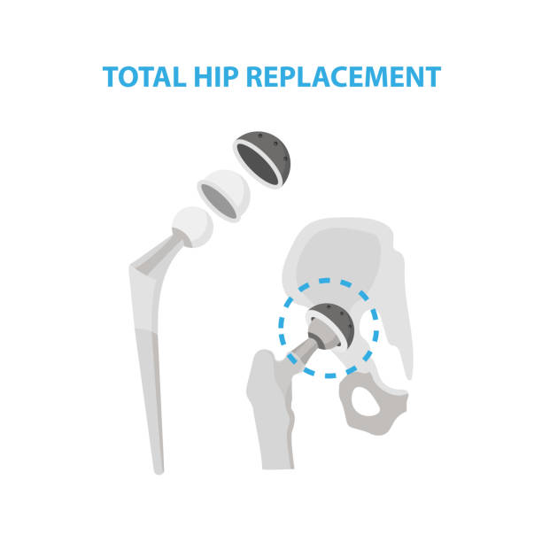 Osteoarthritis of the Hip Joint and Hip Replacement Surgery medical infographic elements isolated on white background. Artificial hip joint construction made from metal infographic elements Osteoarthritis of the Hip Joint and Hip Replacement Surgery medical infographic elements isolated on white background. Artificial hip joint construction made from metal infographic elements. hip replacement stock illustrations