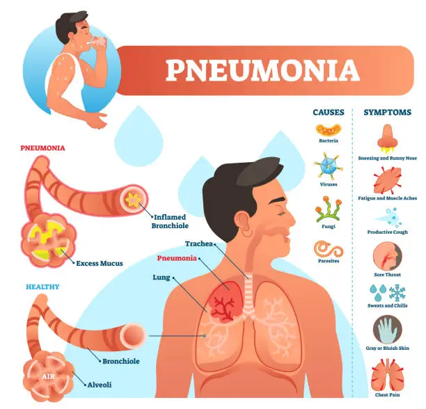 Vector illustration of Pneumonia vector illustration. Labeled diagram with causes and symptoms.