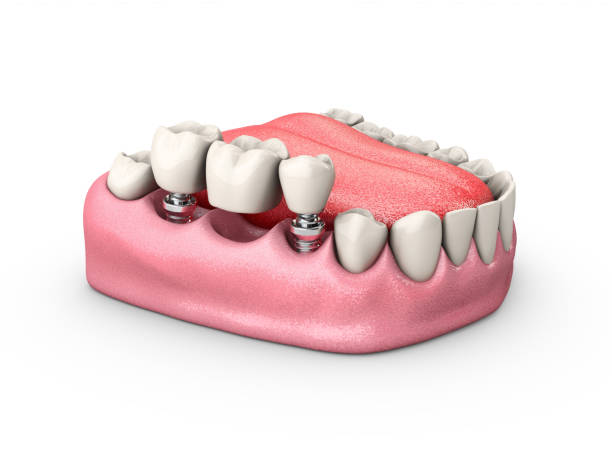 istock 3d Illustration of a Fixed partial denture bridge, isolated white 1047184276