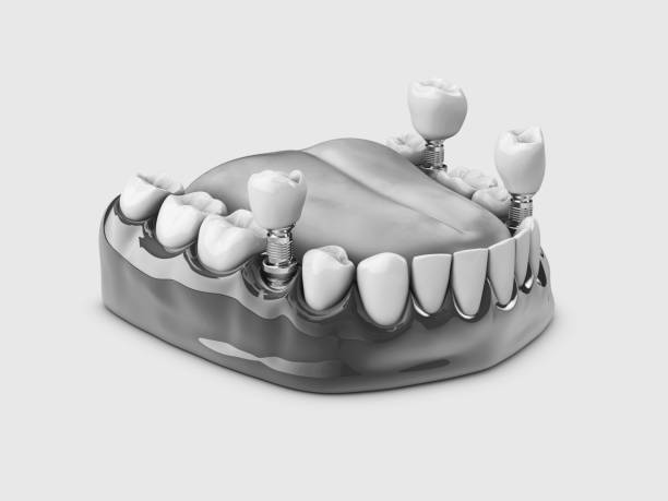 istock Human teeth and Dental implant. black and white 3d illustration 1047184346