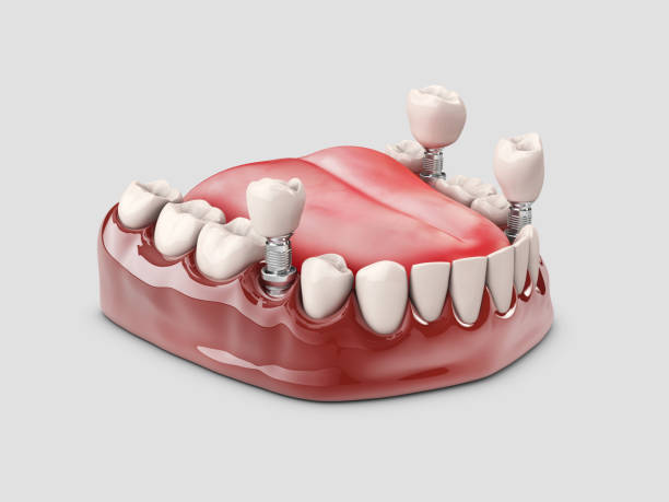istock Human teeth and Dental implant. 3d illustration 1047184364
