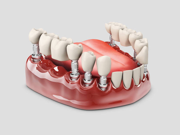 istock 3d Illustration of a Fixed partial denture bridge, isolated white 1047184434